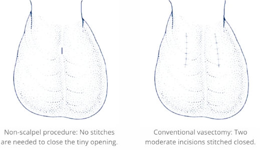 Line drawings of the scrotum before and after a no scalpel vasectomy